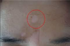 面部白癜风的护理方法有哪些