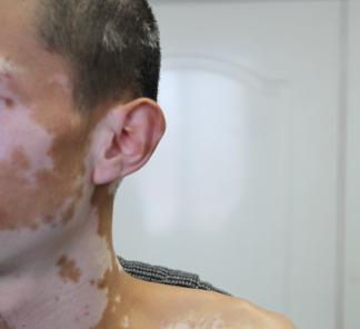  耳朵上的白癜风要怎么护理