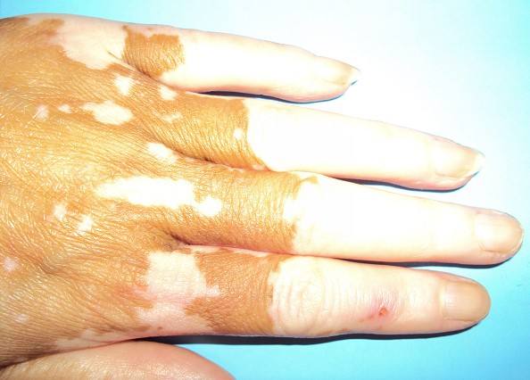 白癜风男性患者如何做好护理