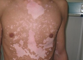  如何防止白癜风反复复发