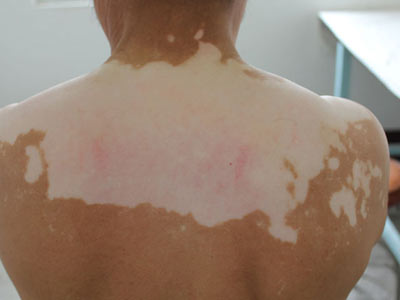  药物治疗白癜风有哪些注意事项