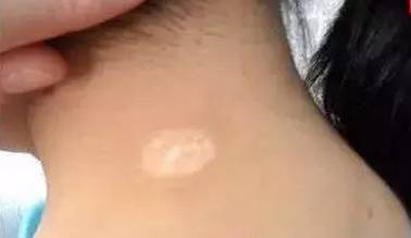  药物治疗白癜风存在哪些弊端