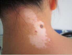 白癜风初期应该如何治疗疗效比较好