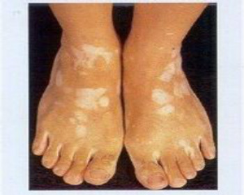 脚部白癜风需要用什么科学的方法进行治疗