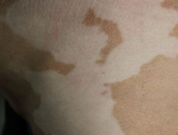  白癜风治疗的影响因素有哪些