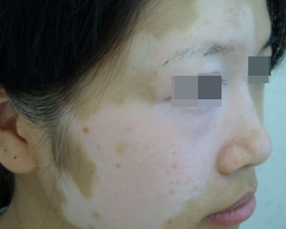 怎么尽快摆脱白癜风的困扰？广州哪里治疗效果好？