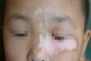 白癜风的治疗方法应该如何选择