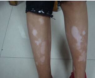腿部白癜风应该如何治疗