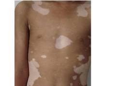 白癜风患者应该如何配合对治疗有利